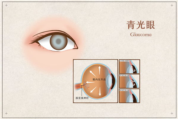 1615247136500366.jpg 摄图网_401804072_青光眼医疗插画(企业商用)_副本.jpg