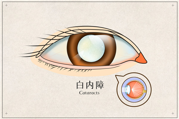 摄图网_401789645_白内障医疗插画（企业商用） (2)_副本.jpg