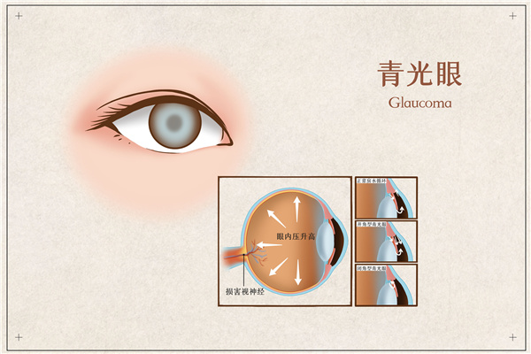 1634860770357734.jpg 摄图网_401804072_青光眼医疗插画(企业商用).jpg