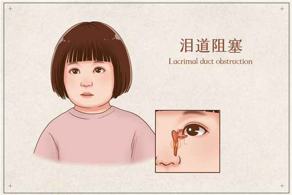 摄图网_401866245_泪道阻塞医疗插画（企业商用）_副本.jpg