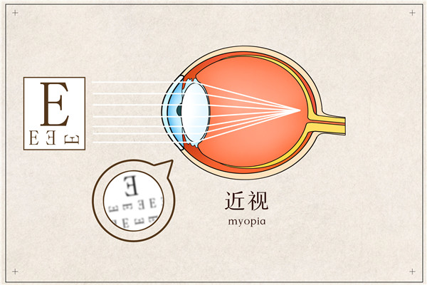 摄图网_401789648_近视医疗插画（企业商用） (2)_副本.jpg