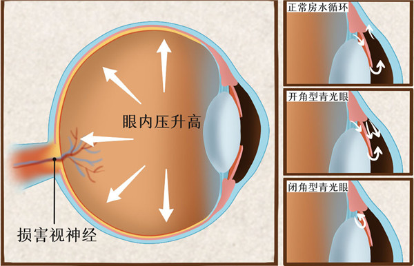 摄图网_401804072_青光眼医疗插画（企业商用）_副本.jpg