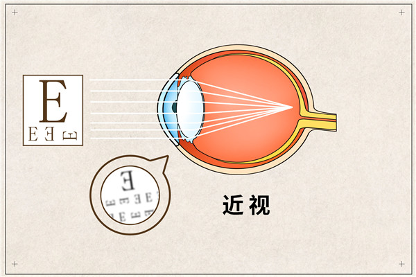 1689923822863859.jpg 摄图网_401789648_近视医疗插画(企业商用)_副本.jpg