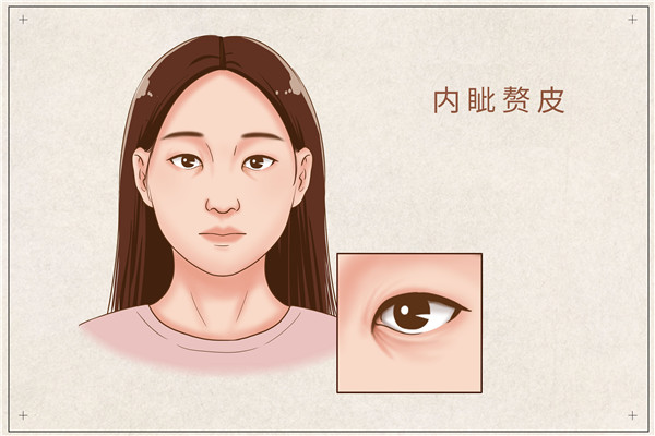 1690278968746963.jpg 摄图网_401866433_内眦赘皮医疗插画(企业商用)_副本.jpg